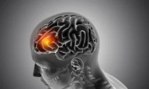 Neurologista comenta aumento de casos de AVC em jovens