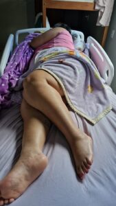 Paciente paraplégica denuncia demora de dois anos para conseguir cirurgia de artrodese na coluna no HGR
