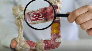 Em 13 anos, doença inflamatória intestinal cresce 5 vezes no Brasil