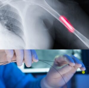 Lifecor alerta sobre risco de paralisação de serviços de cateterismo e angioplastia por dívida de quase R$ 5 milhões da Sesau